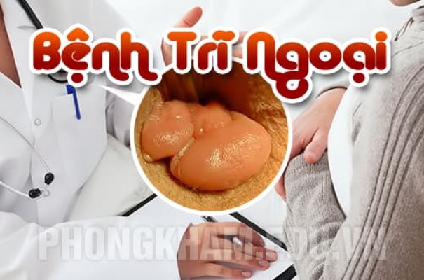 Bệnh trĩ ngoại là gì? nguyên nhân, dấu hiệu, tác hại và cách chữa trị