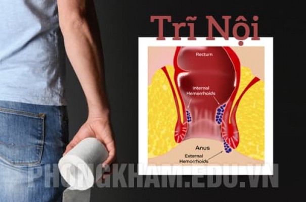 Bệnh trĩ nội là gì? Nguyên nhân, dấu hiệu, tác hại và cách chữa trị