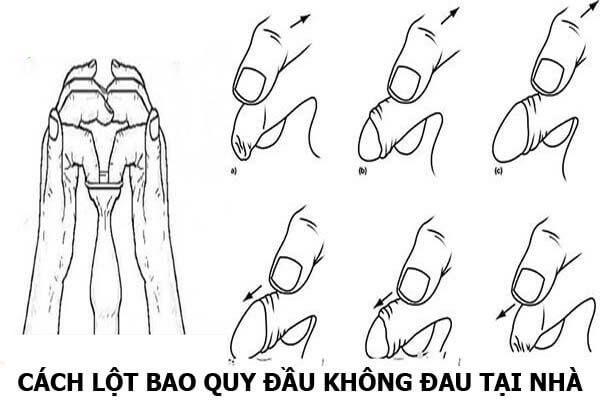 [Tư Vấn] Cách tự lột bao quy đầu dài hoặc hẹp tại nhà không đau an toàn