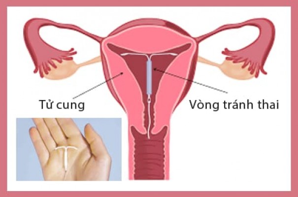 Cách đặt vòng tránh thai như thế nào? Có nguy hiểm không?