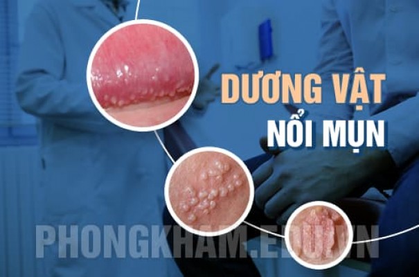 Dương vật nổi mụn trắng đỏ là bệnh gì? Có nguy hiểm không?