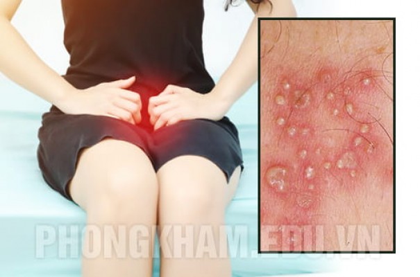 Nổi mụn ở vùng kín nữ là bệnh gì? Top 10 nguyên nhân