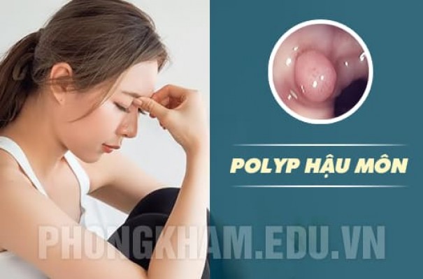 Polyp hậu môn là gì? nguyên nhân, dấu hiệu, tác hại và cách chữa trị