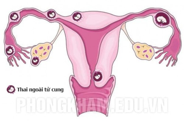 Cách phát hiện mang thai ngoài tử cung và những lưu ý