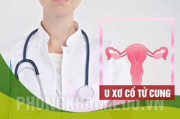 U xơ cổ tử cung là gì? Nguyên nhân, triệu chứng và cách chữa trị hiệu quả