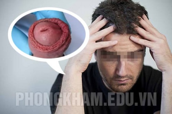 Viêm bao quy đầu là gì? Nguyên nhân, dấu hiệu, tác hại và cách chữa trị