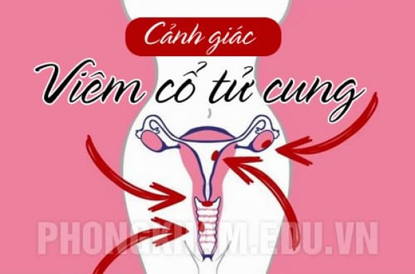 Viêm cổ tử cung là gì? Nguyên nhân, triệu chứng và cách chữa trị