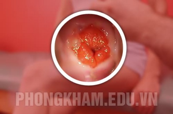Viêm lộ tuyến cổ tử cung là gì? Nguyên nhân, triệu chứng và cách chữa trị