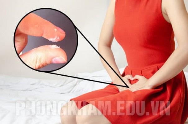 Vùng kín có cặn trắng dấu hiệu của bệnh gì? Cách chữa ra sao