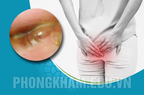 Bệnh apxe hậu môn