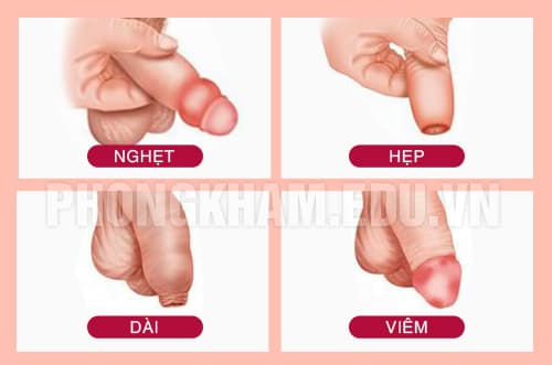 Bệnh về bao quy đầu