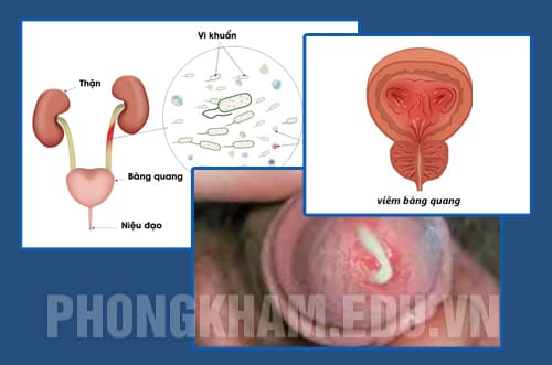 Bệnh về hệ tiết niệu