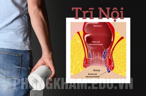 Bệnh trĩ nội