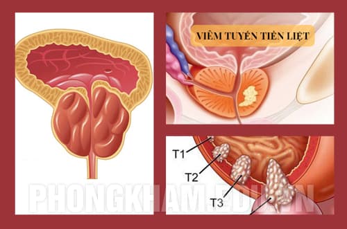 Bệnh về tuyến tiền liệt