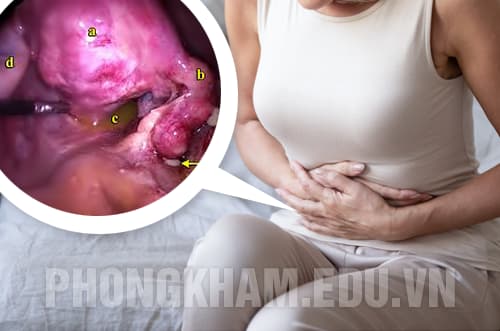 Bệnh viêm vùng chậu