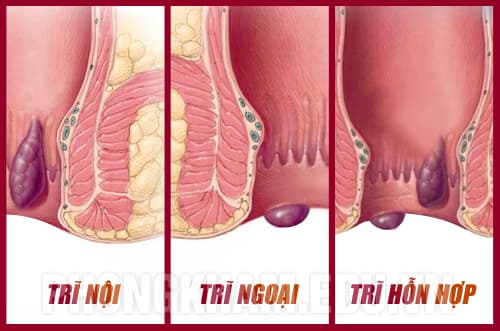 Phân loại bệnh trĩ