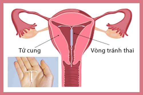 cách đặt vòng tránh thai như thế nào? có nguy hiểm không?