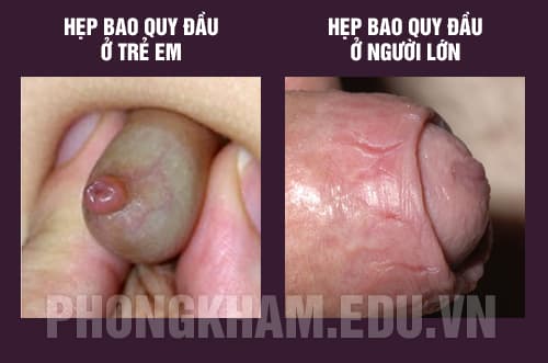 Hình ảnh hẹp bao quy đầu ở trẻ em và người lớn