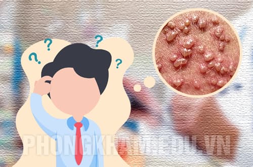 Địa chỉ khám chữa mụn rộp sinh dục ở đâu Hà Nội