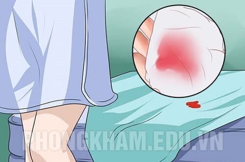 Nguyên nhân khí hư kèm máu