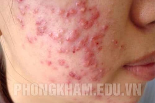 Mụn trứng cá là gì