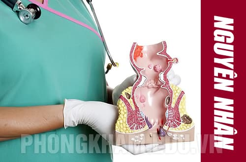 Nguyên nhân gây bệnh trĩ