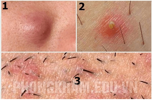 Nổi mụn cứng ở vùng kín nữ giới không đau