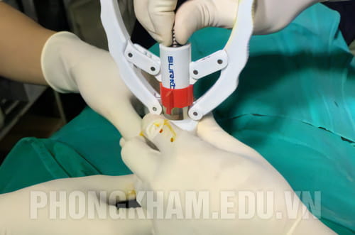 Phương pháp xâm lấn tối thiểu cắt dài bao quy đầu tốt nhất hiện nay