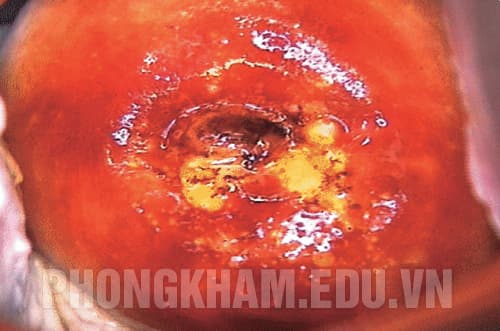 Ung thư cổ tử cung