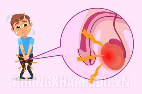 Viêm tinh hoàn là gì? nguyên nhân, dấu hiệu, tác hại và cách chữa trị