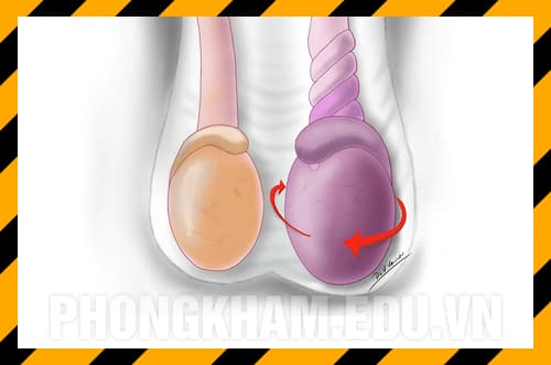 Xoắn tinh hoàn: Nguyên nhân, dấu hiệu, tác hại và cách chữa